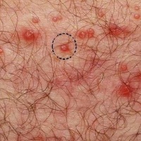 Genital Ulcers Photo - Skin Disease Pictures