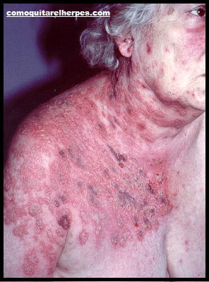 herpes zoster causas y tratamiento