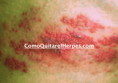 Herpes-en-la-piel-tratamiento